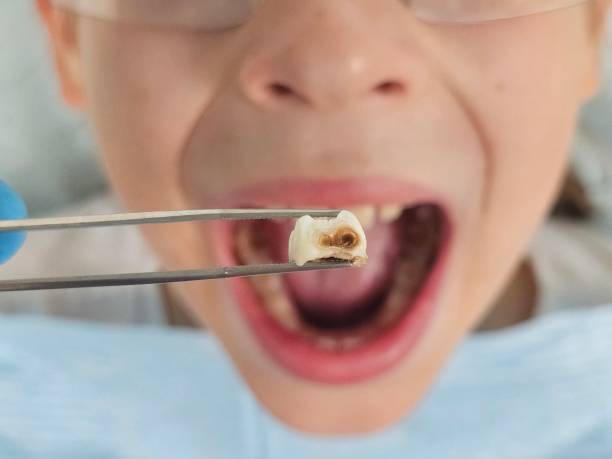 Best Pediatric Emergency Dentist in Johns Creek, GA